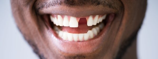 man missing his tooth