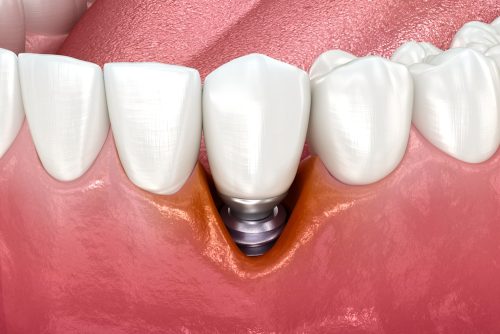 3D signs of peri-implantitis