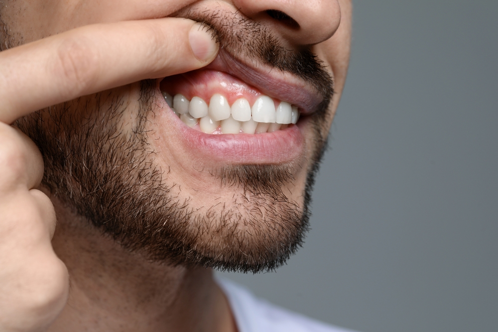 man shows gum tissue