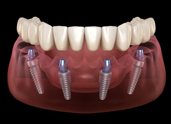 all on 4 dental implants near you