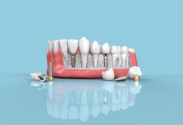 dental implants in San Clemente