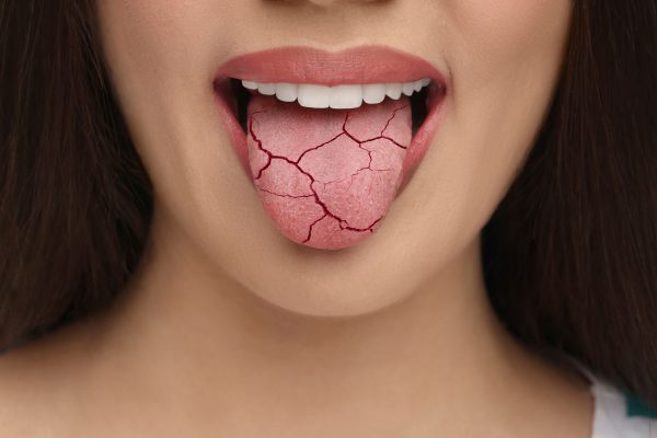 woman sticking out her mouth with a dry tongue