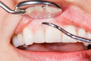 Dental tools being used on front teeth